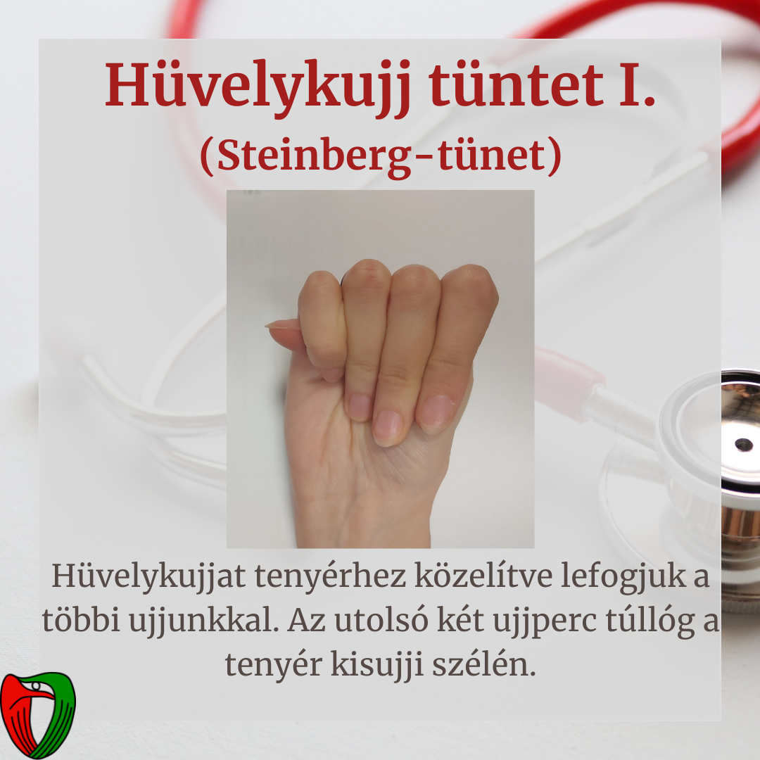 Betegk�nt �s orvosk�nt is fontos felismerni olyan testi t�neteket/fizikai adotts�gokat, melyek jelenl�te nagyban �sszef�gg a Marfan-szindr�ma megl�t�vel.