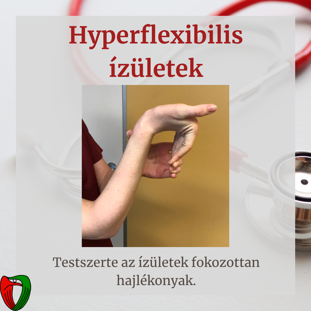 Betegk�nt �s orvosk�nt is fontos felismerni olyan testi t�neteket/fizikai adotts�gokat, melyek jelenl�te nagyban �sszef�gg a Marfan-szindr�ma megl�t�vel.