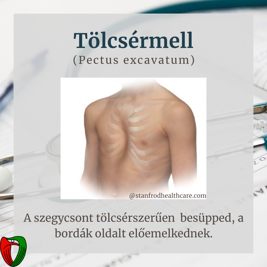 Betegk�nt �s orvosk�nt is fontos felismerni olyan testi t�neteket/fizikai adotts�gokat, melyek jelenl�te nagyban �sszef�gg a Marfan-szindr�ma megl�t�vel.