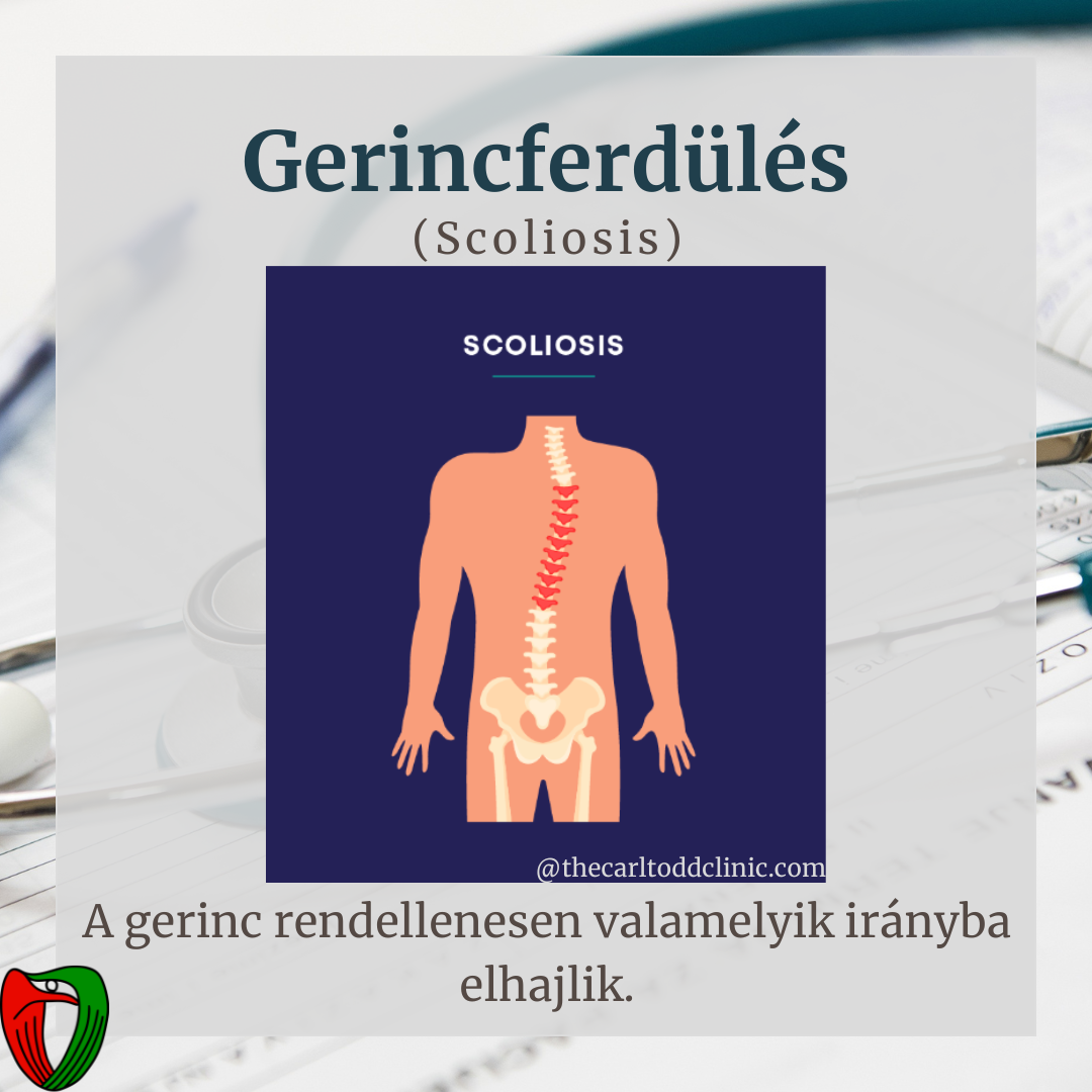 Betegk�nt �s orvosk�nt is fontos felismerni olyan testi t�neteket/fizikai adotts�gokat, melyek jelenl�te nagyban �sszef�gg a Marfan-szindr�ma megl�t�vel.