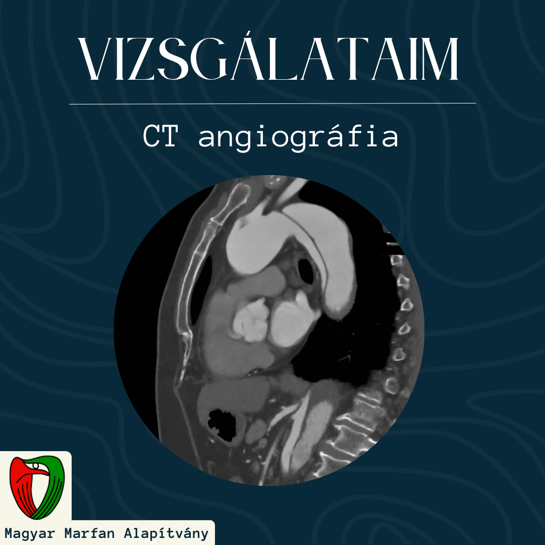 A CT angiogr�fia egy olyan speci�lis vizsg�lat, amely lehet�s�get ad a szervezetben l�v� erek lefut�s�nak vizsg�lat�ra.